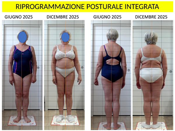 Prima e dopo di un percorso di riprogrammazione posturale integrata a Verbania con miglioramento dell’allineamento corporeo
